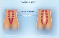 Diastasis Rectus Abdominus 1 Six Physio