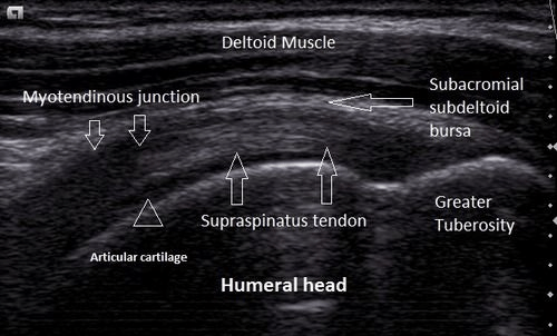 Taking a Deeper Look… Diagnostic MSK Ultrasound 2 Deltoid Muscle